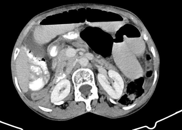 Acute small bowel (ileal) volvulus (Radiopaedia 71740-82139 Axial C+ portal venous phase 82).jpg