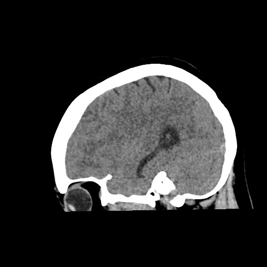 Acute subarachnoid hemorrhage and accessory anterior cerebral artery (Radiopaedia 69231-79008 Sagittal non-contrast 19).jpg