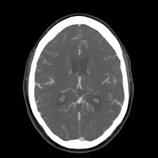 Acute subarachnoid hemorrhage and accessory anterior cerebral artery (Radiopaedia 69231-79009 D 40).jpg