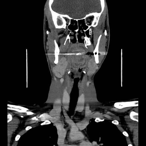 File:Acute submandibular sialadenitis secondary to ductal stone (Radiopaedia 27999-28267 D 25).jpg