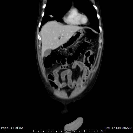 Acute superior mesenteric artery occlusion (Radiopaedia 43636-47060 Coronal C+ portal venous phase 2).jpg