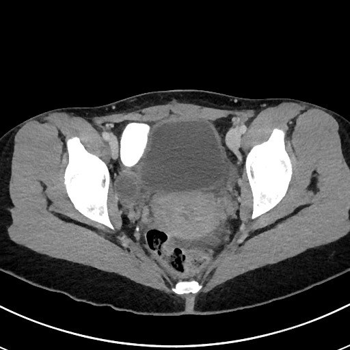 File:Acute uncomplicated appendicitis (Radiopaedia 61374-69304 Axial 82).jpg