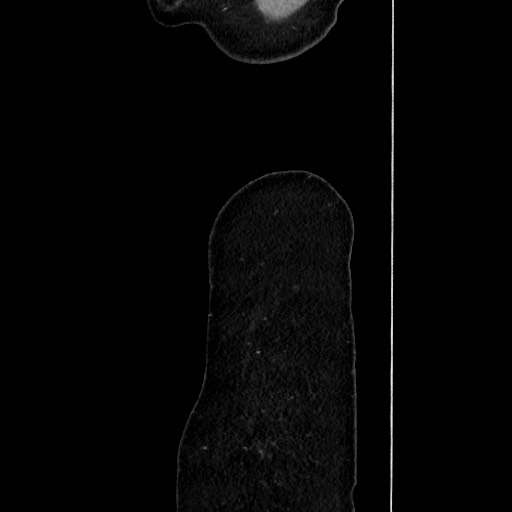 File:Acute uncomplicated appendicitis (Radiopaedia 73704-84499 Sagittal C+ portal venous phase 198).jpg