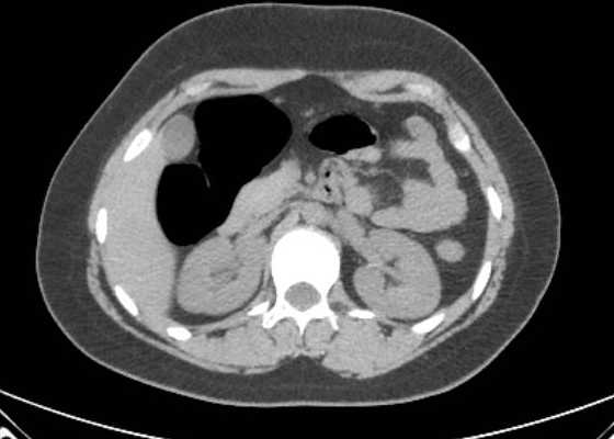 Acute unilateral nonhemorrhagic adrenal infarction (Radiopaedia 67560-76957 Axial non-contrast 57).jpg