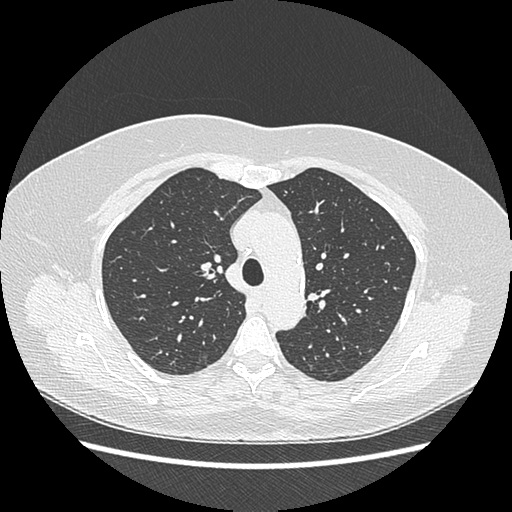 Adenocarcinoma in situ of lung (Radiopaedia 38685-40829 B 73).png