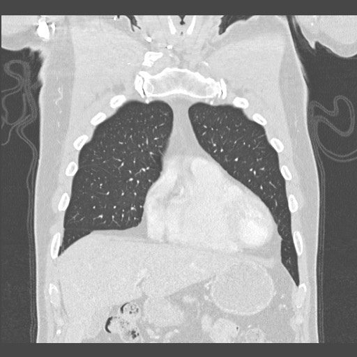 Adenocarcinoma of the lung (Radiopaedia 59871-67325 Coronal lung window 10).jpg