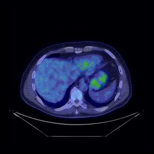 File:Adenocarcinoma of the lung (Radiopaedia 59871-67326 Fused axial 47).jpg