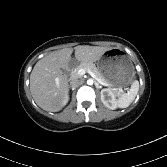 File:Adenocystic carcinoma of the trachea (Radiopaedia 47677-52525 Axial C+ arterial phase 82).jpg