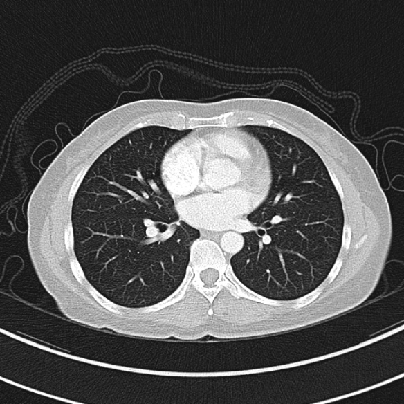 Adenocystic carcinoma of the trachea (Radiopaedia 47677-52525 Axial lung window 56).jpg