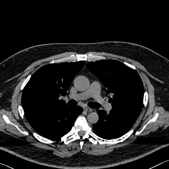 Adenoid cystic carcinoma of the trachea (Radiopaedia 49042-54137 Axial non-contrast 145).jpg