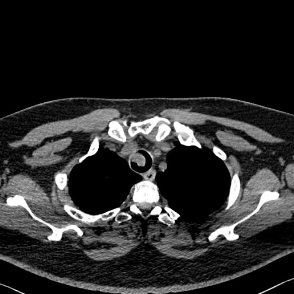 Adenoid cystic carcinoma of the trachea (Radiopaedia 49042-54137 Axial non-contrast 52).jpg