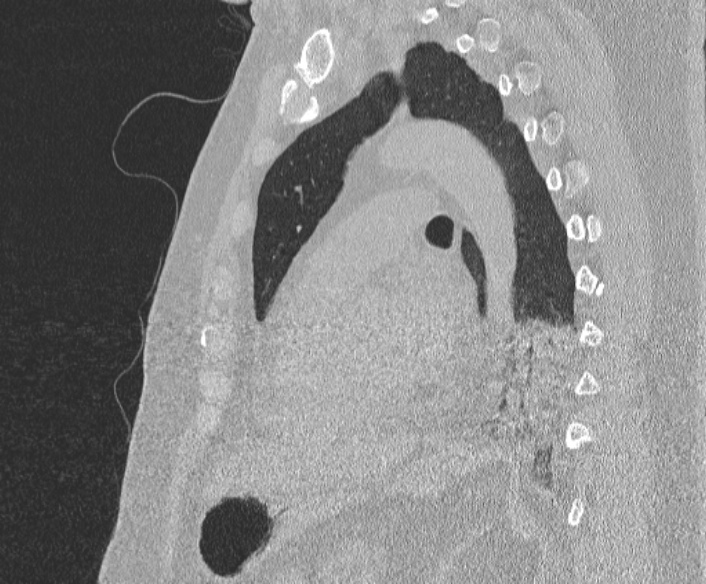 Adenoid cystic carcinoma of the trachea (Radiopaedia 49042-54137 Sagittal lung window 281).jpg
