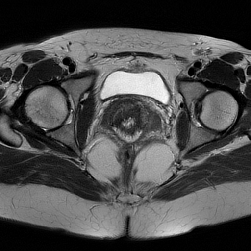File:Adenomyosis-scar endometriosis (Radiopaedia 65863-75022 Axial T2 21).jpg