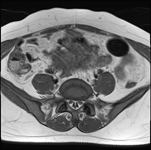 File:Adenomyosis - ovarian endometriomas (Radiopaedia 67031-76350 Axial T1 5).jpg