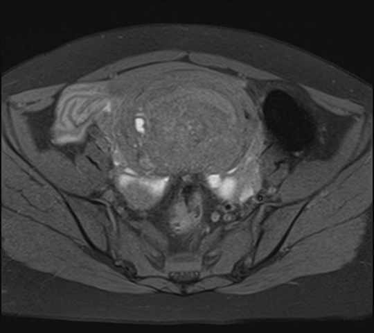 File:Adenomyosis - ovarian endometriomas (Radiopaedia 67031-76350 Axial T1 fat sat 11).jpg