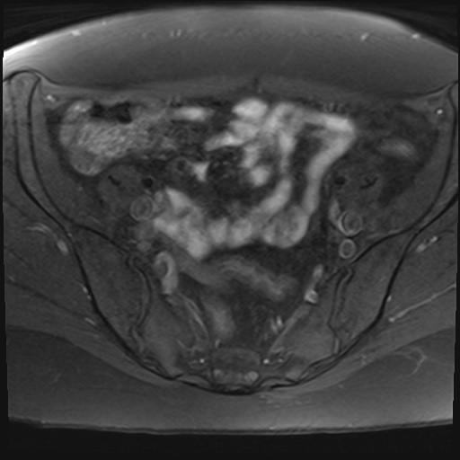File:Adenomyosis and endometriotic cysts (Radiopaedia 82300-96367 Axial T1 fat sat 23).jpg