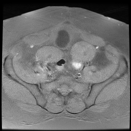 File:Adenomyosis within a didelphys uterus (Radiopaedia 70175-80215 Axial T1 fat sat 18).jpg