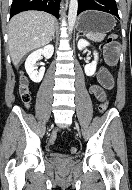 Adhesional small bowel obstruction (Radiopaedia 58900-66131 Coronal C+ portal venous phase 163).jpg
