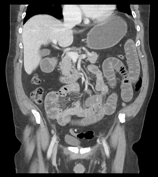 Adhesions within abdominal wall hernia (Radiopaedia 58283-65394 Coronal C+ portal venous phase 33).png