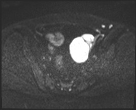 Adnexal multilocular cyst (O-RADS US 3- O-RADS MRI 3) (Radiopaedia 87426-103754 Axial DWI 41).jpg