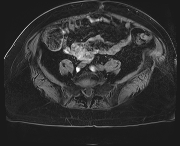 Adrenal cortical carcinoma (Radiopaedia 64017-72770 Axial T1 C+ fat sat 66).jpg