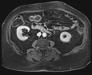 Adrenal cortical carcinoma (Radiopaedia 64017-72770 K 54).jpg