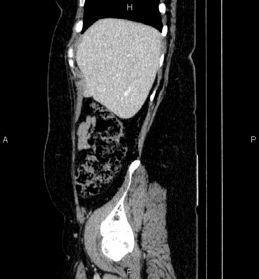 Adrenal cortical carcinoma (Radiopaedia 84882-100379 Sagittal C+ portal venous phase 15).jpg