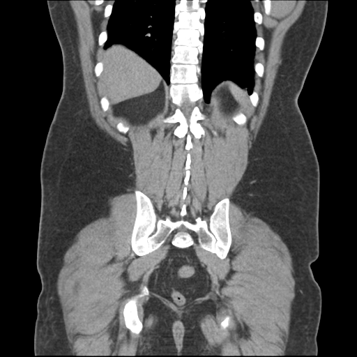 Adrenal cyst (Radiopaedia 45625-49776 Coronal C+ portal venous phase 57).png