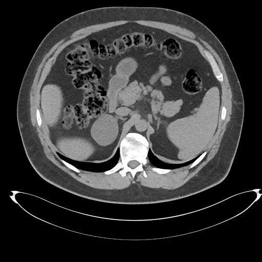 File:Adrenal cyst (Radiopaedia 45625-49778 Axial non-contrast 32).png