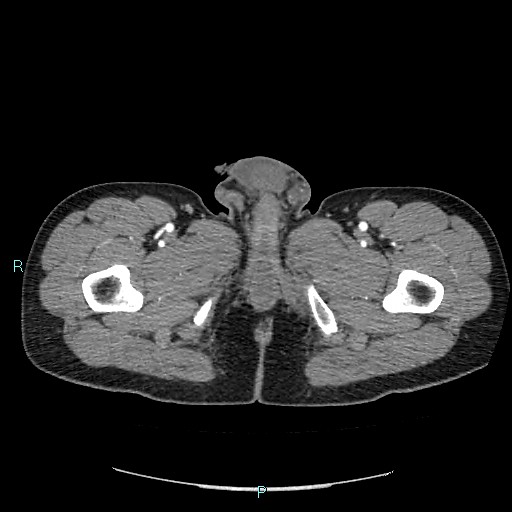 Adrenal cystic lymphangioma (Radiopaedia 83161-97534 Axial C+ arterial phase 112).jpg