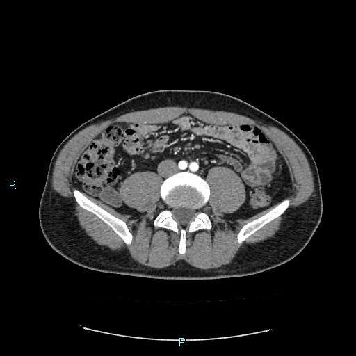 Adrenal cystic lymphangioma (Radiopaedia 83161-97534 Axial C+ arterial phase 60).jpg