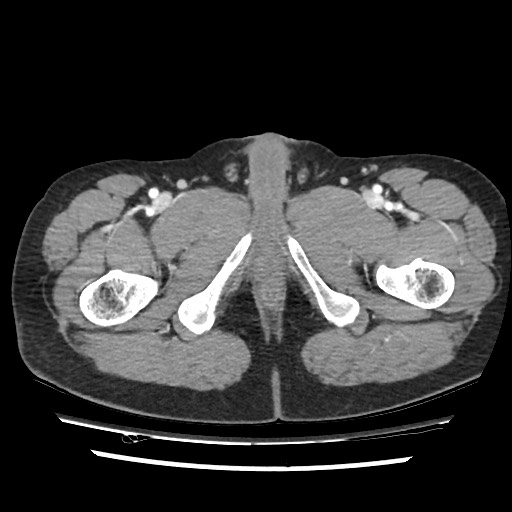 Adrenal gland trauma (Radiopaedia 81351-95078 Axial Dual bolus trauma C+ 127).jpg