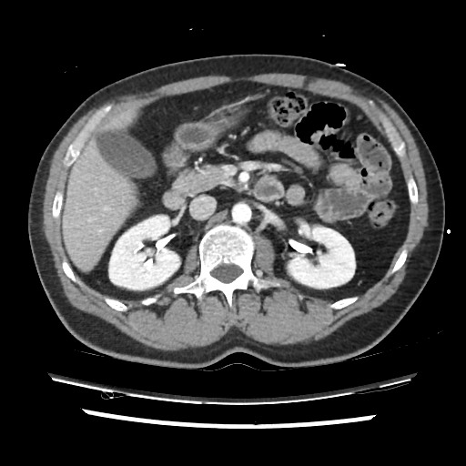 Adrenal gland trauma (Radiopaedia 81351-95078 Axial Dual bolus trauma C+ 71).jpg