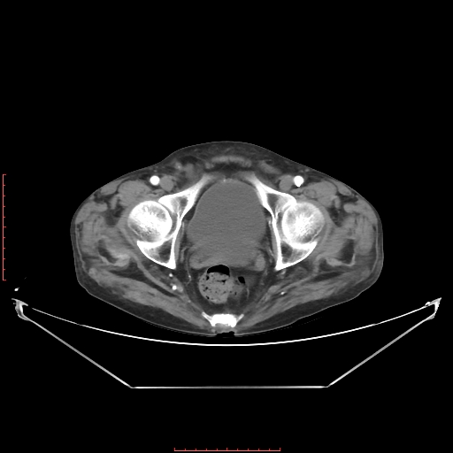 Adrenal hemangioma (Radiopaedia 68923-78668 Axial C+ arterial phase 68).jpg