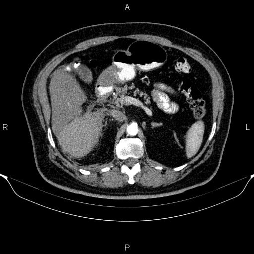 File:Adrenal hemorrhage (Radiopaedia 62622-70916 Axial C+ arterial phase 131).jpg