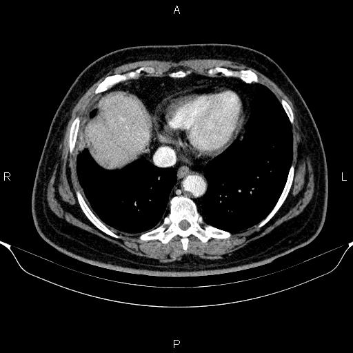 Adrenal hemorrhage (Radiopaedia 62622-70916 Axial C+ portal venous phase 8).jpg