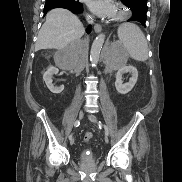 Adrenal lymphoma (Radiopaedia 84145-99415 Coronal C+ portal venous phase 51).jpg