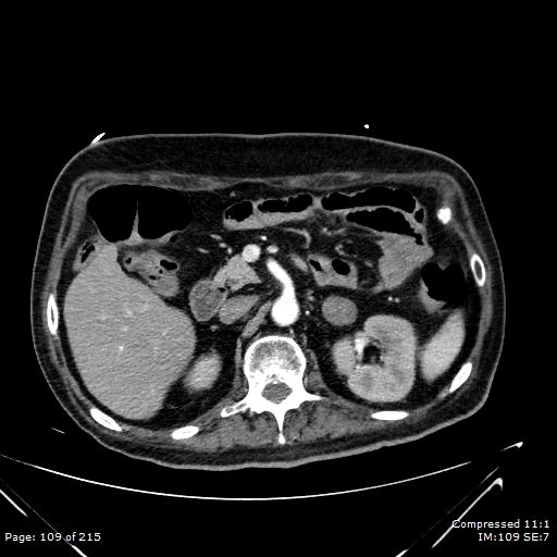 File:Adrenal metastasis (Radiopaedia 78425-91079 Axial C+ arterial phase 39).jpg
