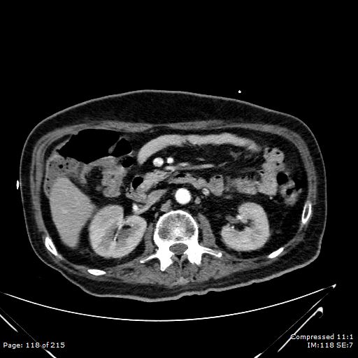 Adrenal metastasis (Radiopaedia 78425-91079 Axial C+ arterial phase 48).jpg