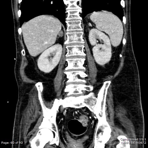 Adrenal metastasis (Radiopaedia 78425-91079 Sagittal C+ portal venous phase 47).jpg