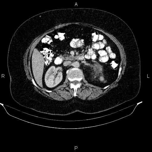 Adrenal myelolipoma (Radiopaedia 84319-99617 Axial renal cortical phase 49).jpg