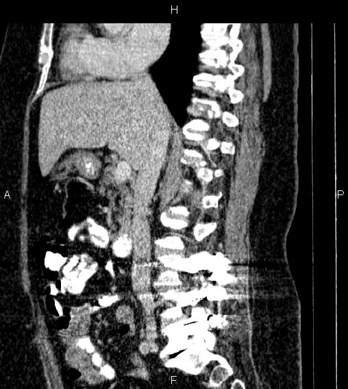 File:Adrenal myelolipoma (Radiopaedia 84319-99617 Sagittal renal cortical phase 42).jpg