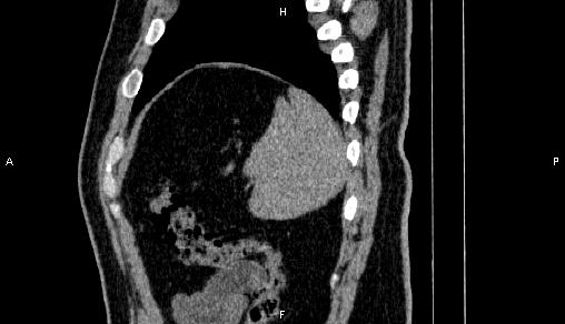 Adrenal myelolipoma (Radiopaedia 84321-99619 Sagittal non-contrast 94).jpg
