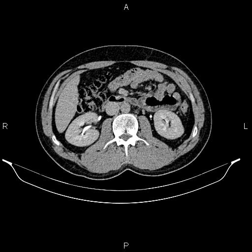 Adrenal myelolipoma (Radiopaedia 87794-104246 Axial renal excretory phase 45).jpg