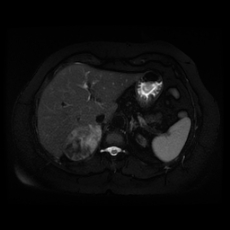 File:Adrenal myelolipoma - MRI (Radiopaedia 83249-97646 Axial STIR 12).jpg
