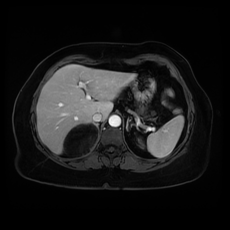 Adrenal myelolipoma - MRI (Radiopaedia 83249-97646 T1 fat sat arterial phase 21).jpg