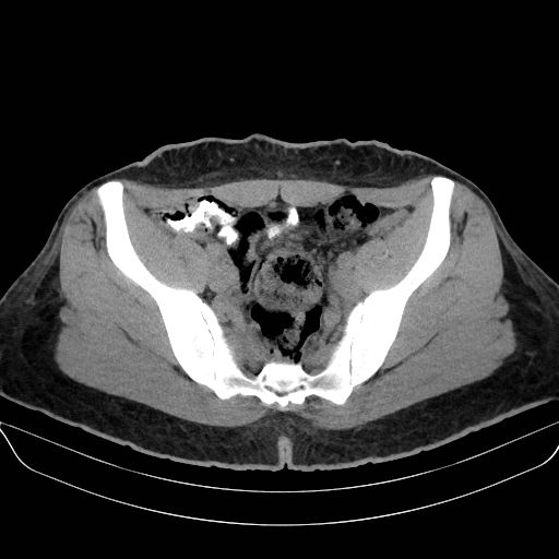 Adrenal myelolipoma - bilateral (Radiopaedia 74805-85810 Axial non-contrast 66).jpg