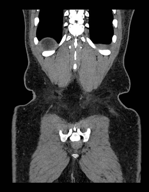 Adrenal myelolipoma - bilateral (Radiopaedia 74805-85810 Coronal C+ portal venous phase 63).jpg