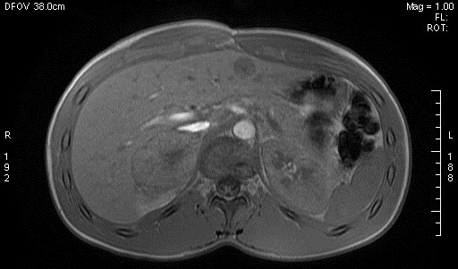 File:Adrenal pheochromocytoma (Radiopaedia 35133-36730 Axial T1 out-of-phase 5).jpg