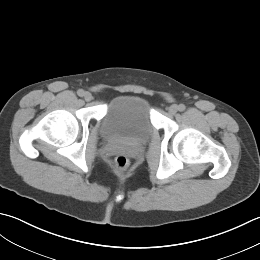 Adult polycystic kidney disease (Radiopaedia 47866-52626 Axial non-contrast 83).png